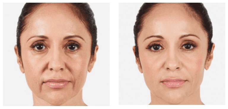 Dermal Filler before and after