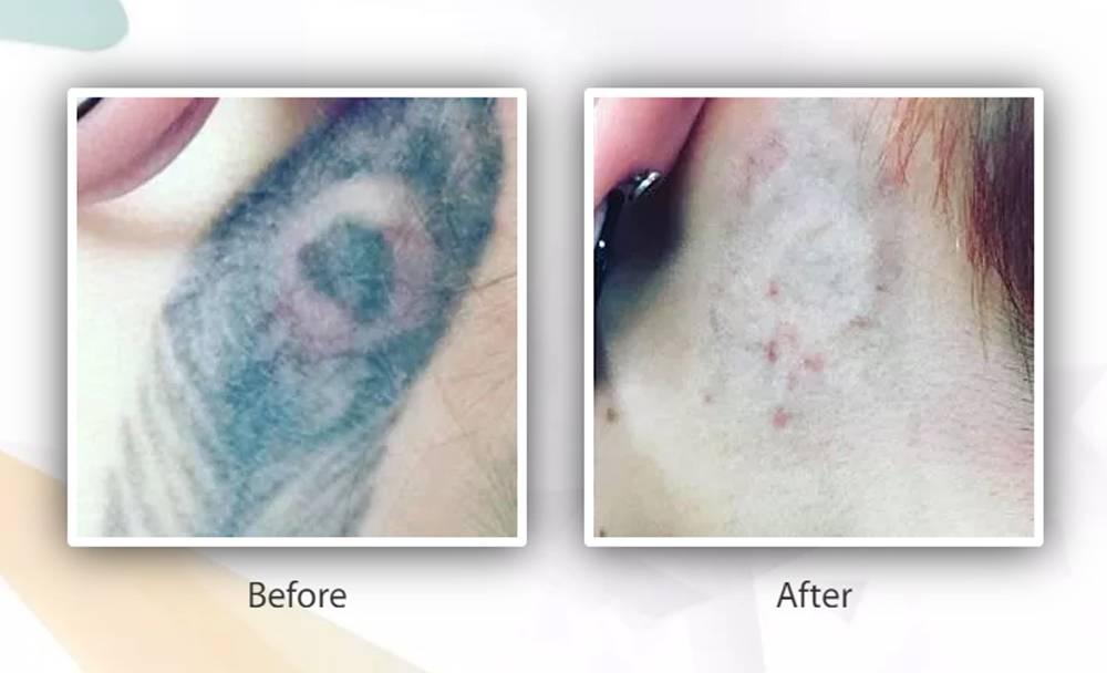 Tattoo Removal before and after Pictures