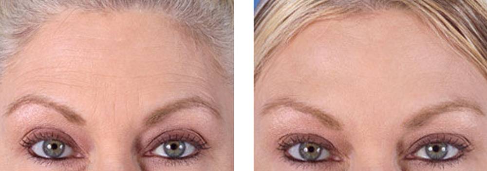anti wrinkle before and after