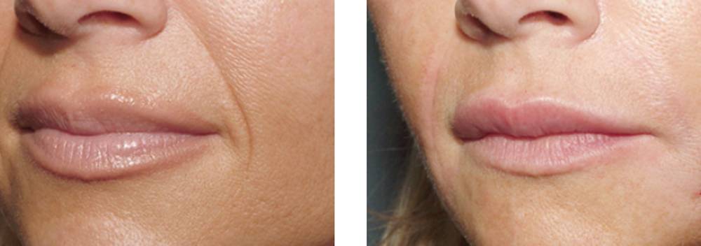 Nasolabial folds before and after