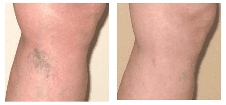 tHREAD VEIN BEFORE AND AFTER