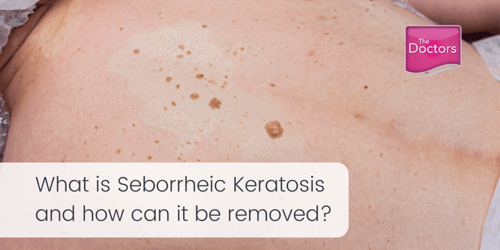 Laser Ablation For Seborrheic Keratosis At Ruth Tolbert Blog Laser Ablation For Seborrheic Keratosis At Ruth Tolbert Blog