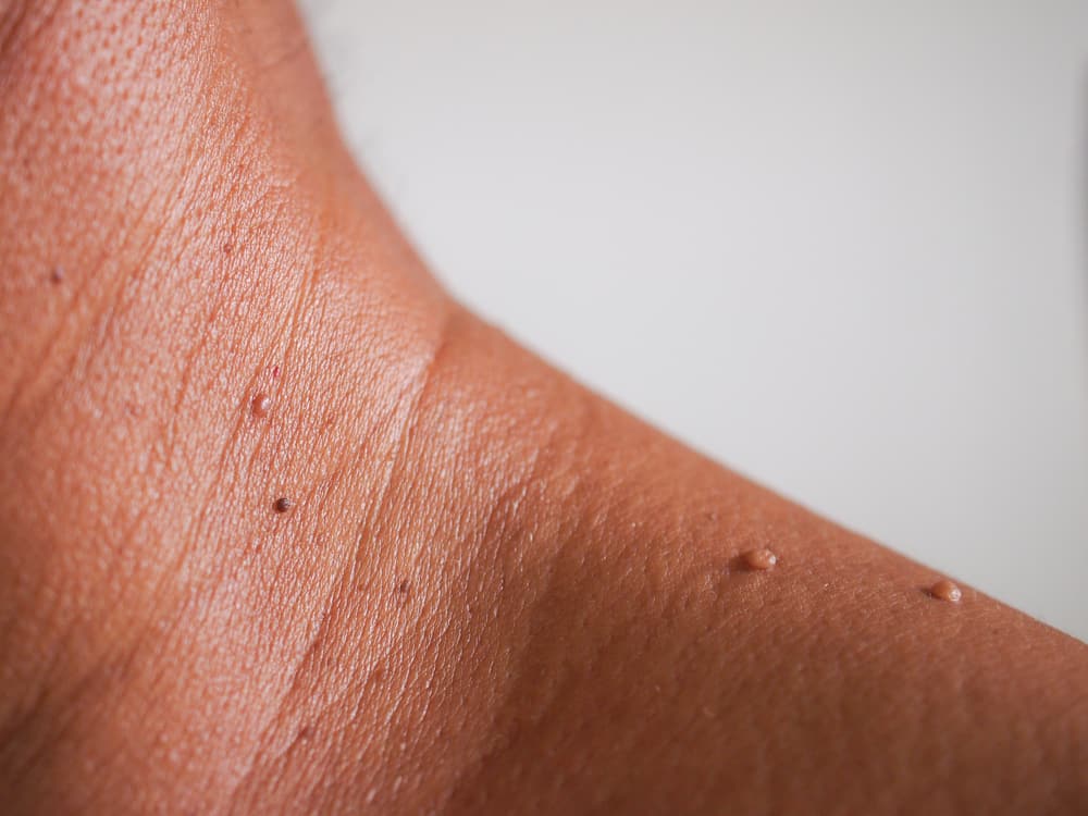 Skin tag removal Norwich