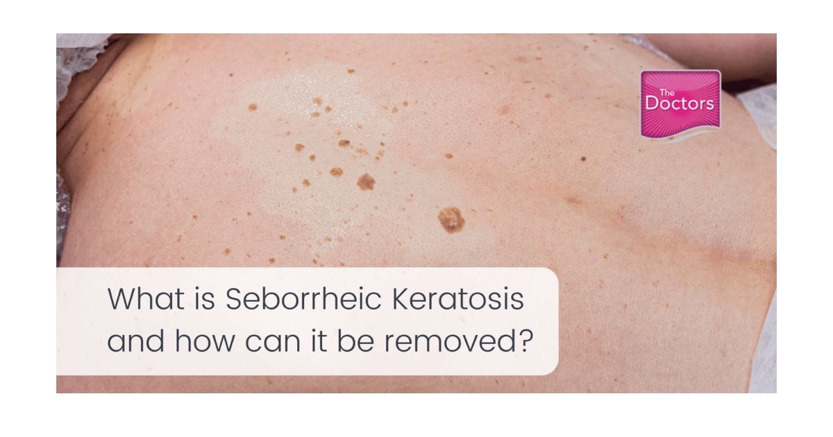 what is seborrheic keratosis