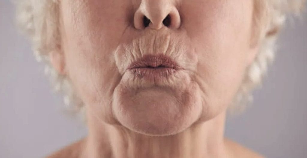 the effects of smoking on the skin