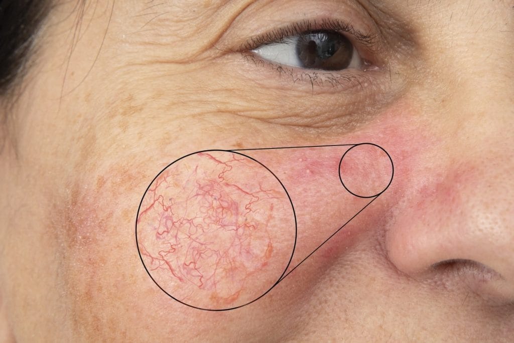 womans face with broken capillaries