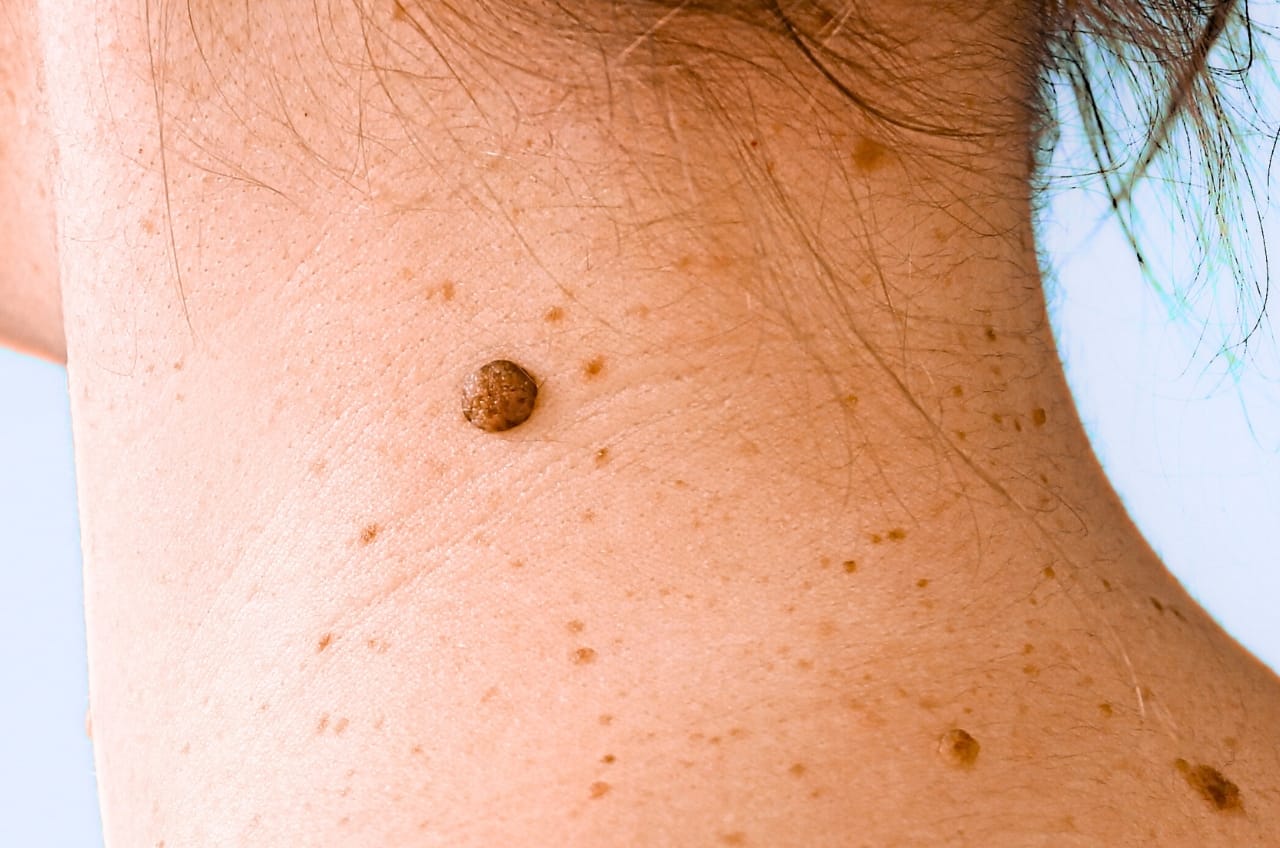 large mole on neck