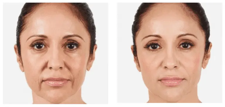 dermal fillers Norwich